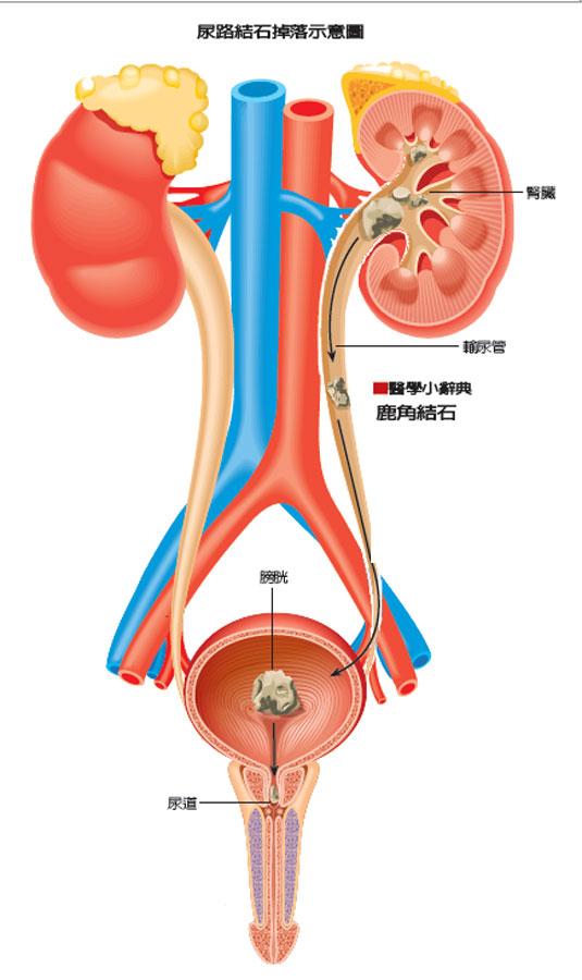 (2)结石 肾盂,输尿管,膀胱,尿道,任何部位结石,当结石移动时划破尿路