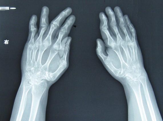 系统性红疮狼斑