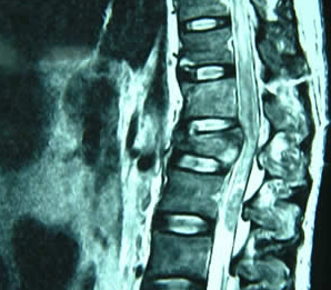 脊柱骨折和脊髓损伤