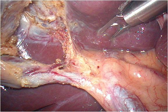 腹腔镜胆囊切 除 术