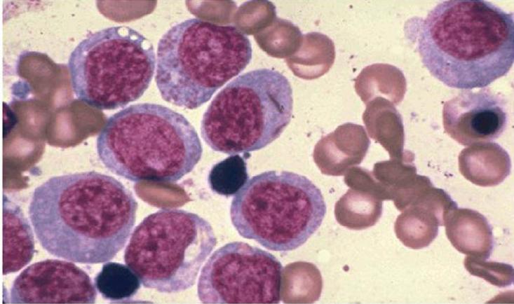 非霍奇金淋巴瘤的症状和治愈的概率_其它疾病_奇飞知识网