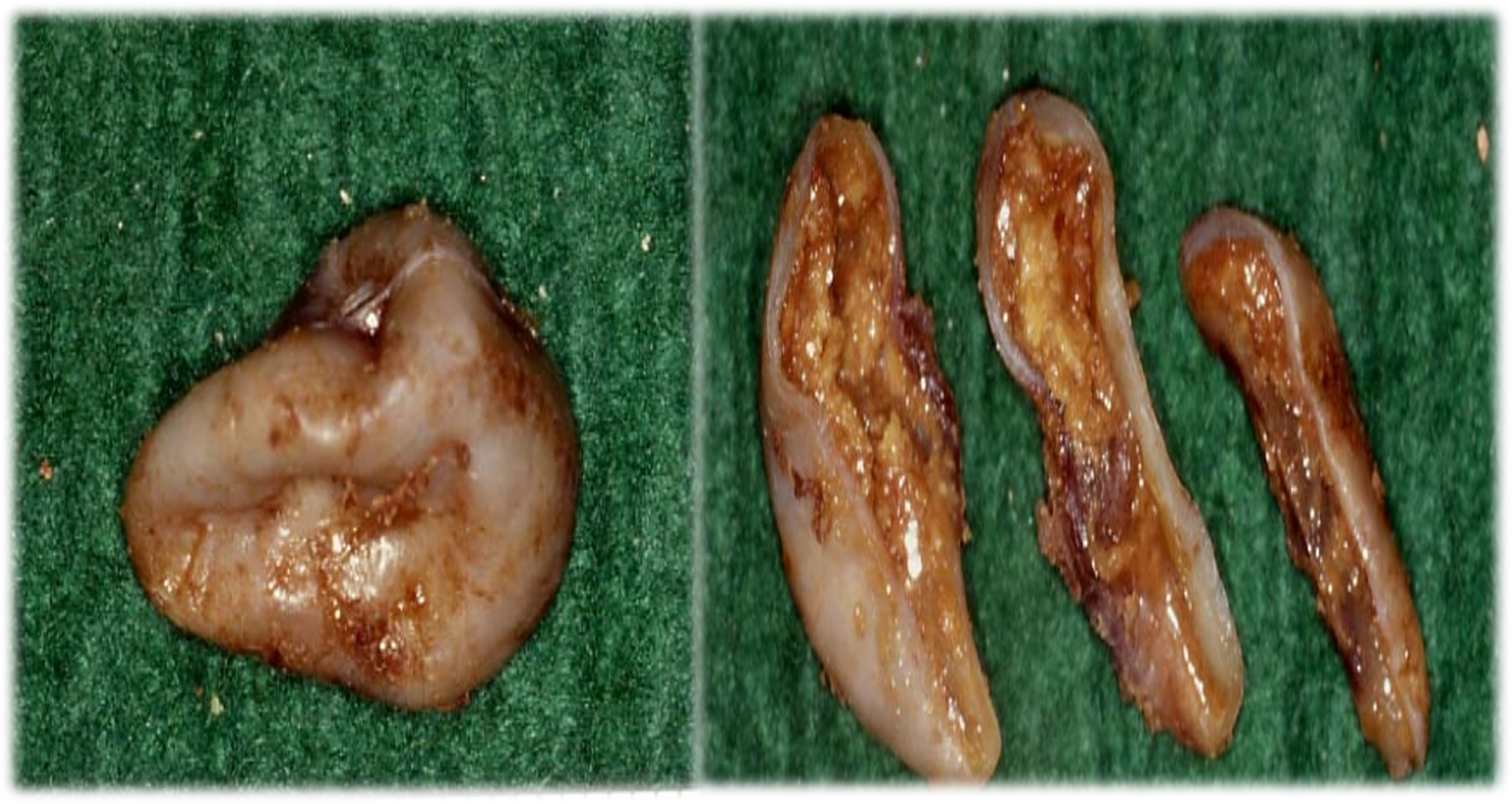 13.1-5 牙源性角化囊肿(肉眼).jpg