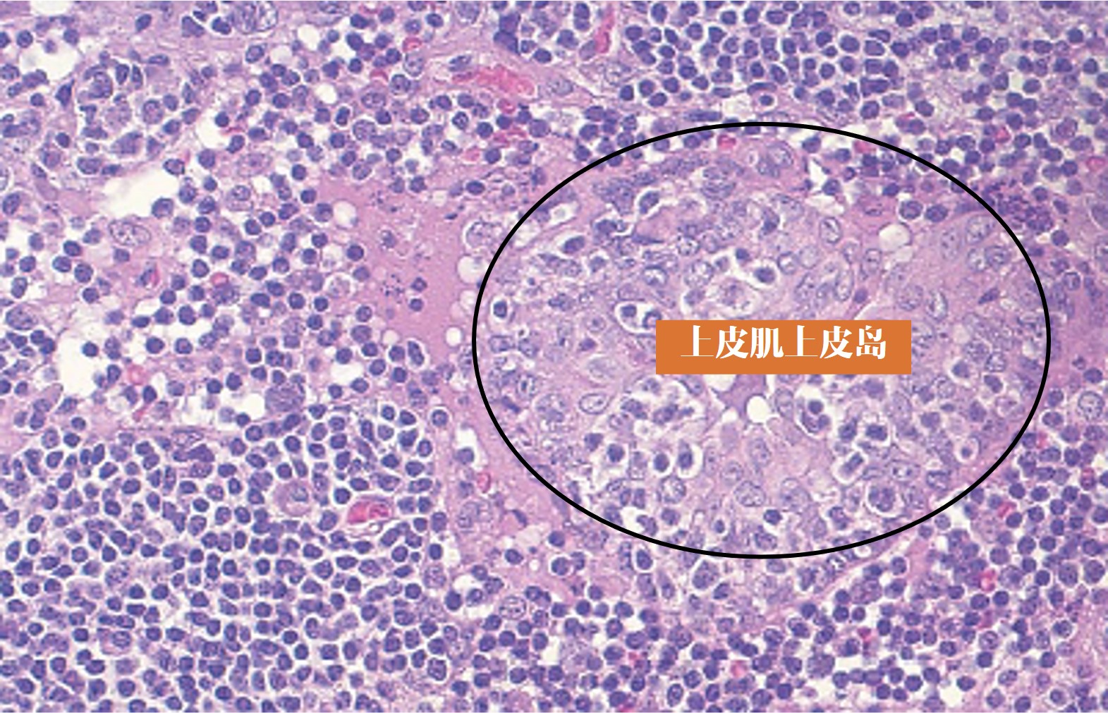 12.1-11 舍格伦综合征(上皮肌上皮岛).jpg