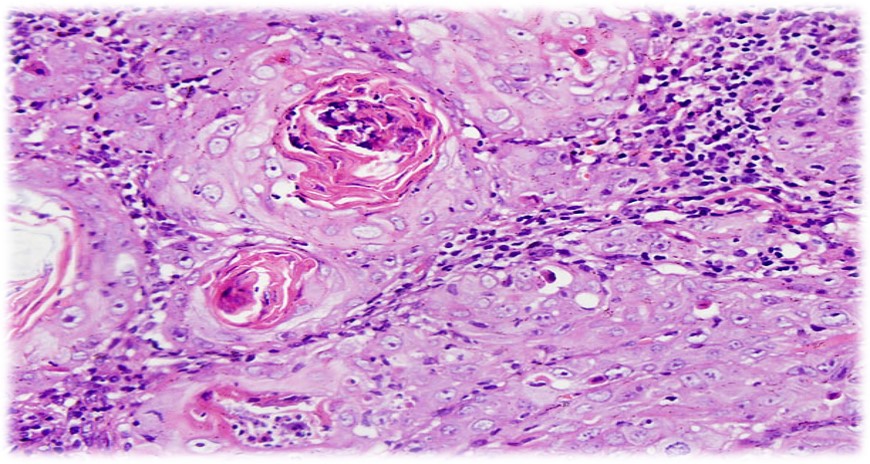 15.1-5 中分化鳞状细胞癌.jpg