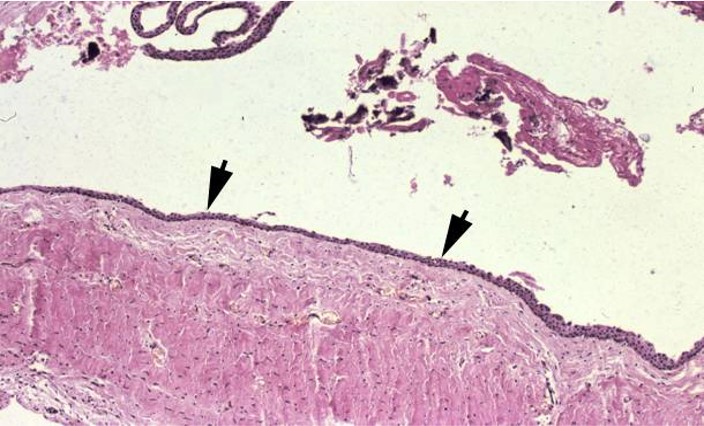 13.1-3 含牙囊肿(光镜).jpg