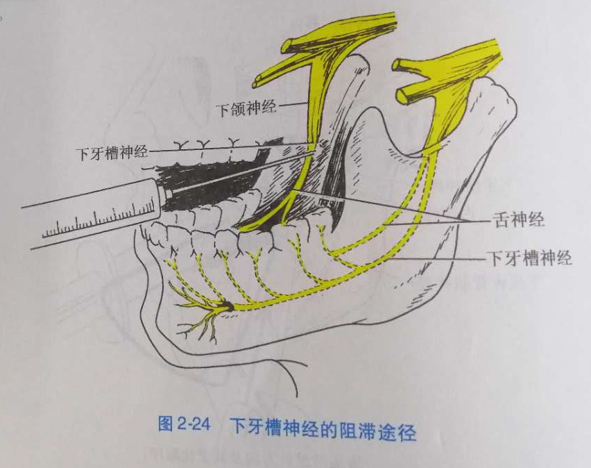 下牙槽神经阻滞.jpg