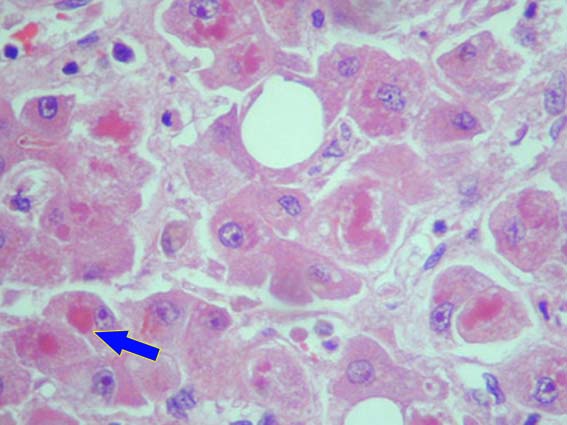 肝细胞玻璃样变.jpg