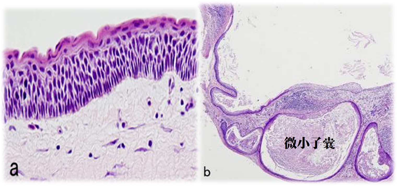 13.1-6 牙源性角化囊肿(光镜).jpg