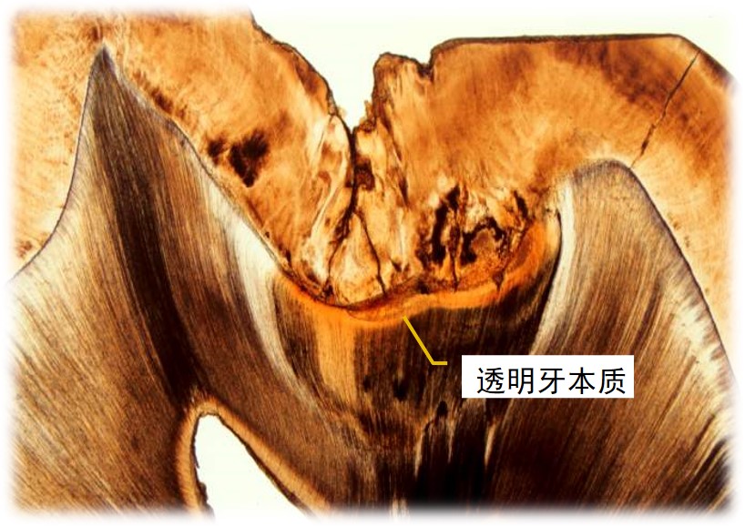 3.2-11 透明牙本质.jpg