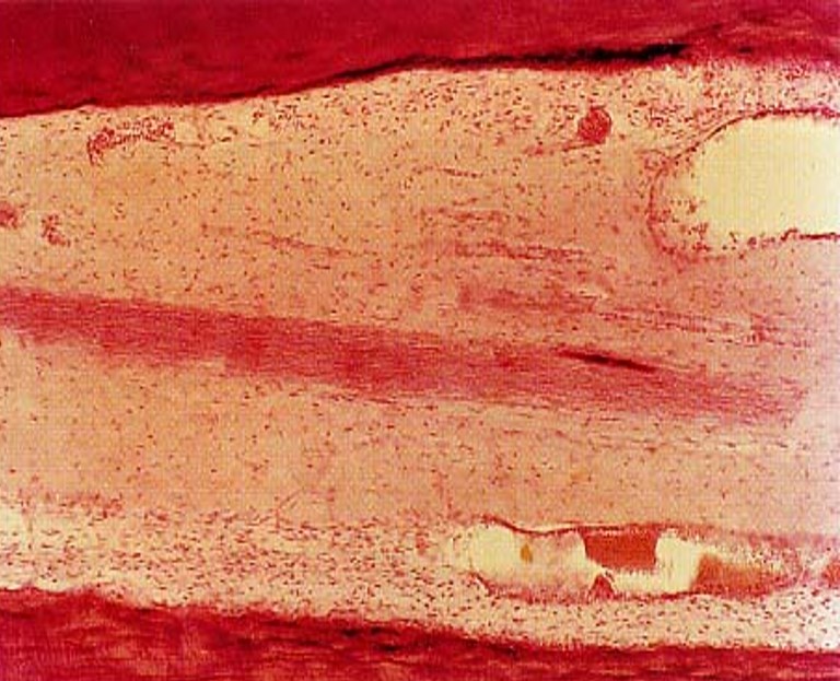 8.2-4 牙髓纤维性变.jpg