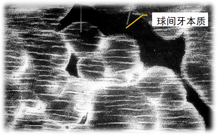 3.2-5 球间牙本质.jpg