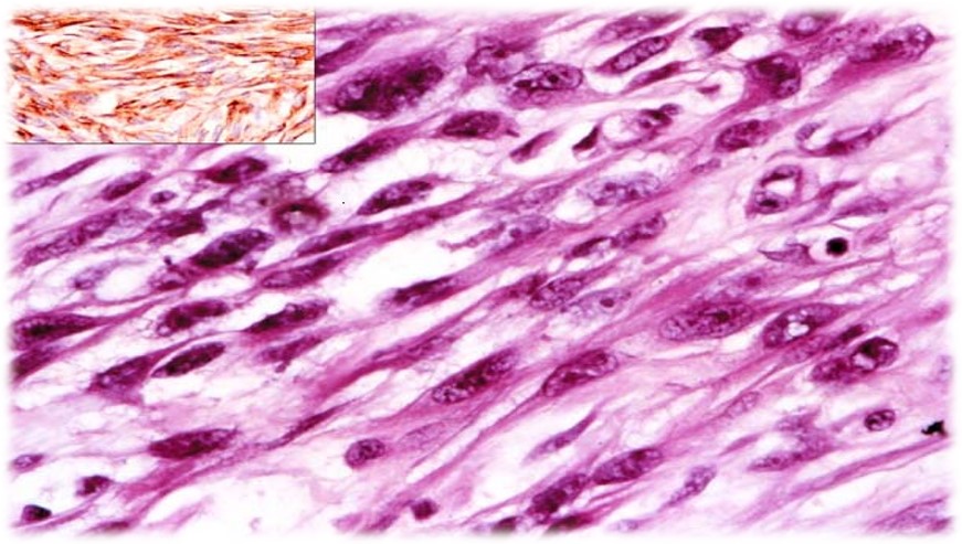 15.1-10 梭形细胞癌.jpg
