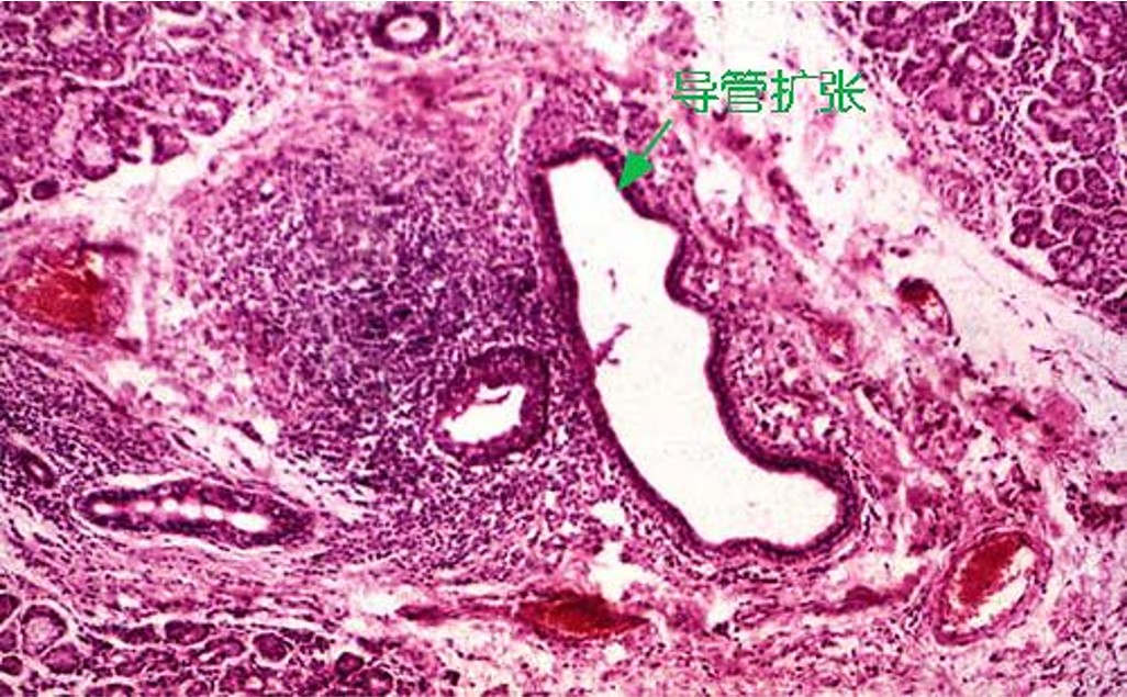 12.1-9 舍格伦综合征(发展).jpg