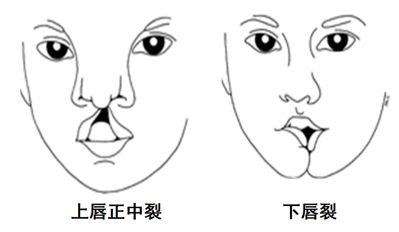 1.2-9 唇裂.jpg