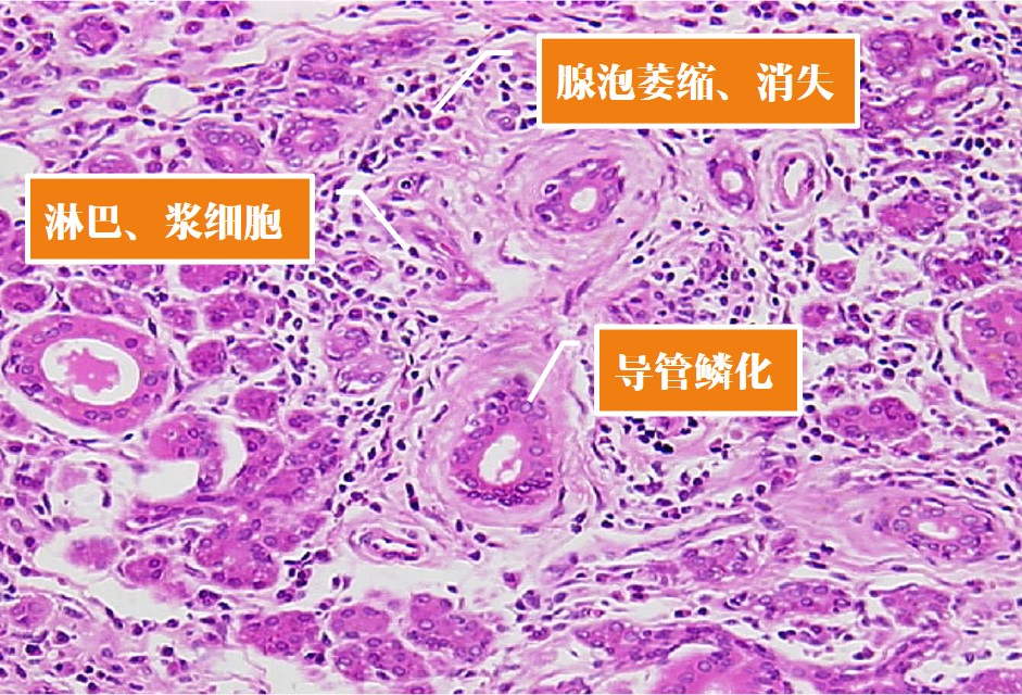 12.1-3 慢性唾液腺炎(光镜下).jpg
