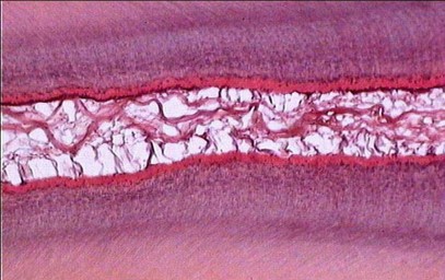 8.2-3 网状萎缩.jpg