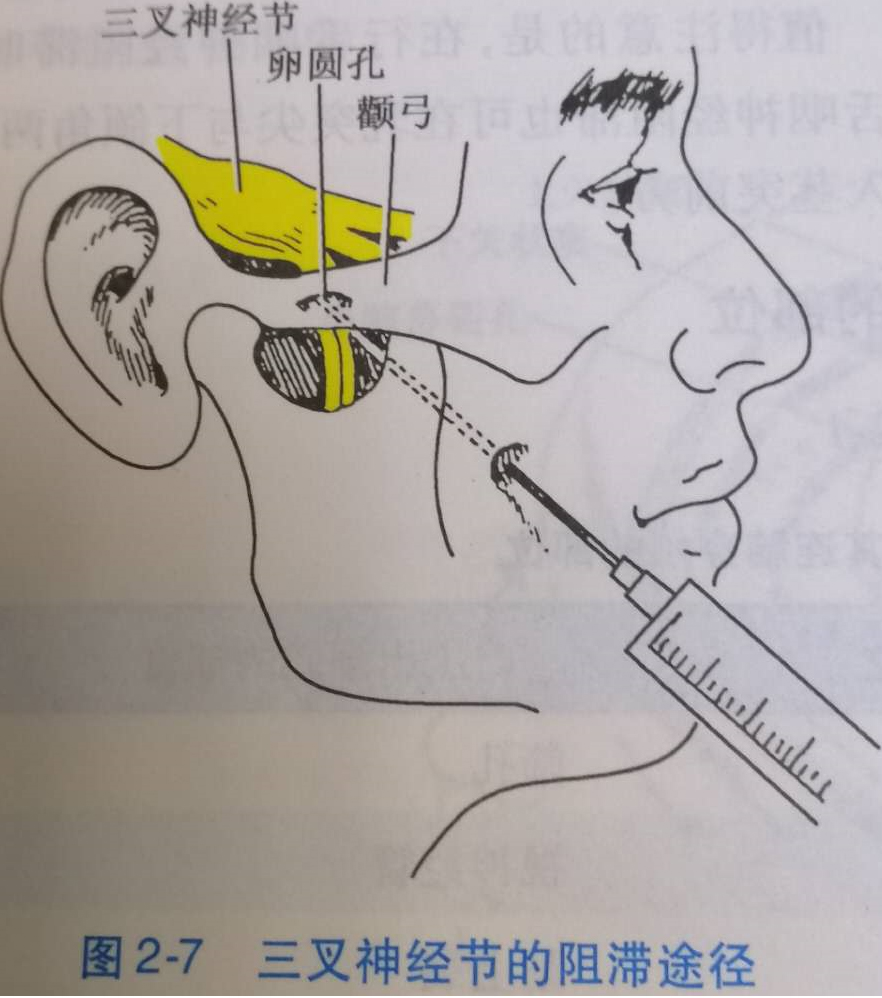 三叉神经阻滞途径.jpg