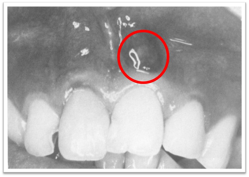 9.1-1 黏膜下脓肿.jpg