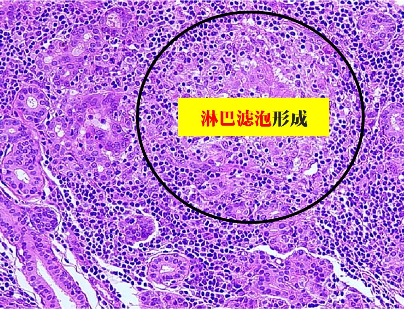 12.1-4 慢性复发性腮腺炎.jpg