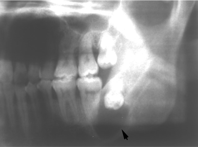 13.1-1 含牙囊肿(X线).jpg