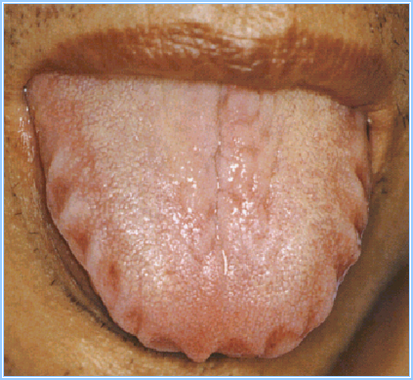 裂纹或裂沟中有无舌苔覆盖,是判断病理性和先天性裂纹的标志.