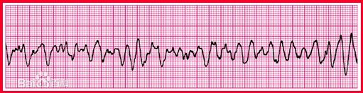 室颤心电图