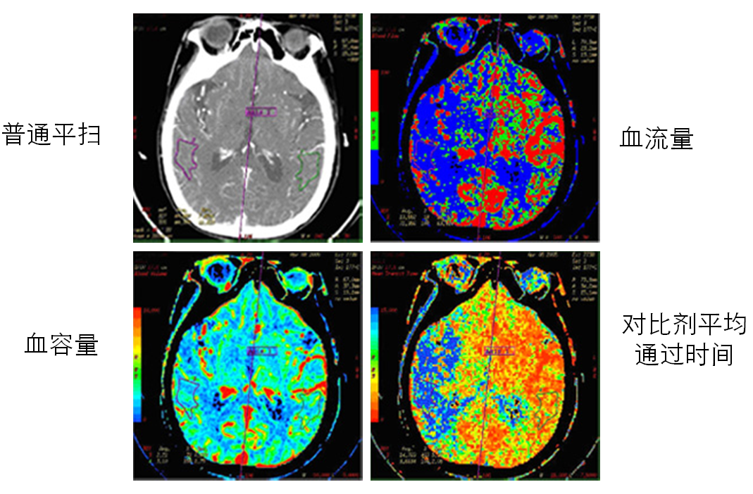 1.脑缺血ct灌注成像