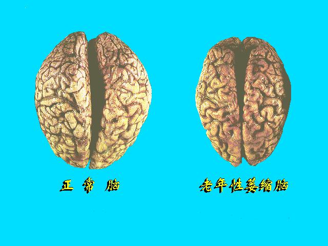 (一)类型 生理性萎缩 病理性萎缩 1.营养不良性萎缩 肝硬化