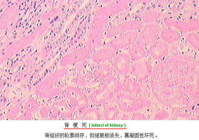 (1)基本病理变化 细胞核的改变: 核浓缩 核碎裂 干酪样坏死 结核杆菌