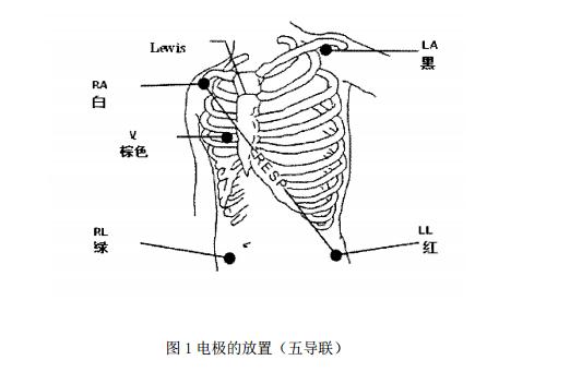 五导联装置的electrode 安放如图 6-5:右臂电极,安放在锁骨下,靠近