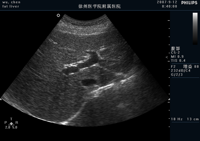 肝脏各径线正常测值