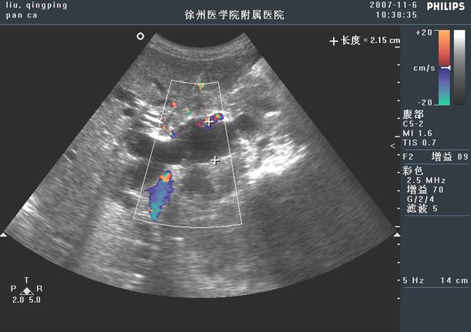 超声和ct诊断胰岛细胞瘤14例_医学论文