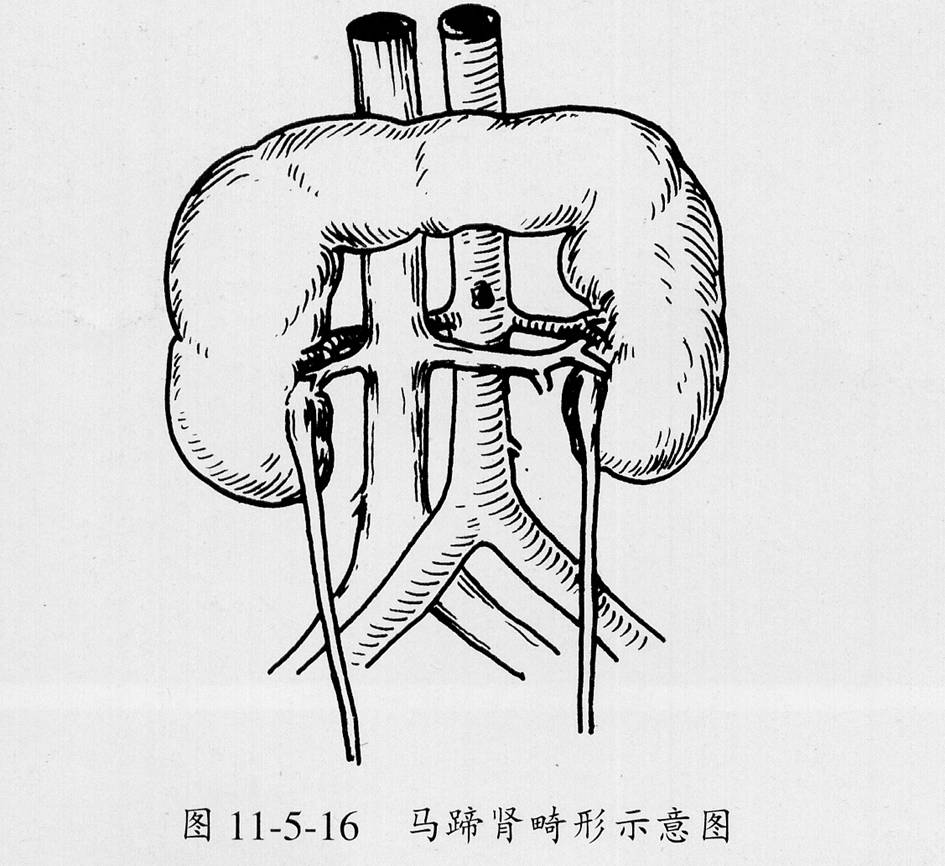 同侧融合肾是一侧出现两肾上下融合,形态拉长,肾窦回声分为上下两团