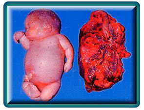 贫血出生3-6月发现症状,若不治疗5岁前死亡 重型α-地贫(bart"s水肿 )