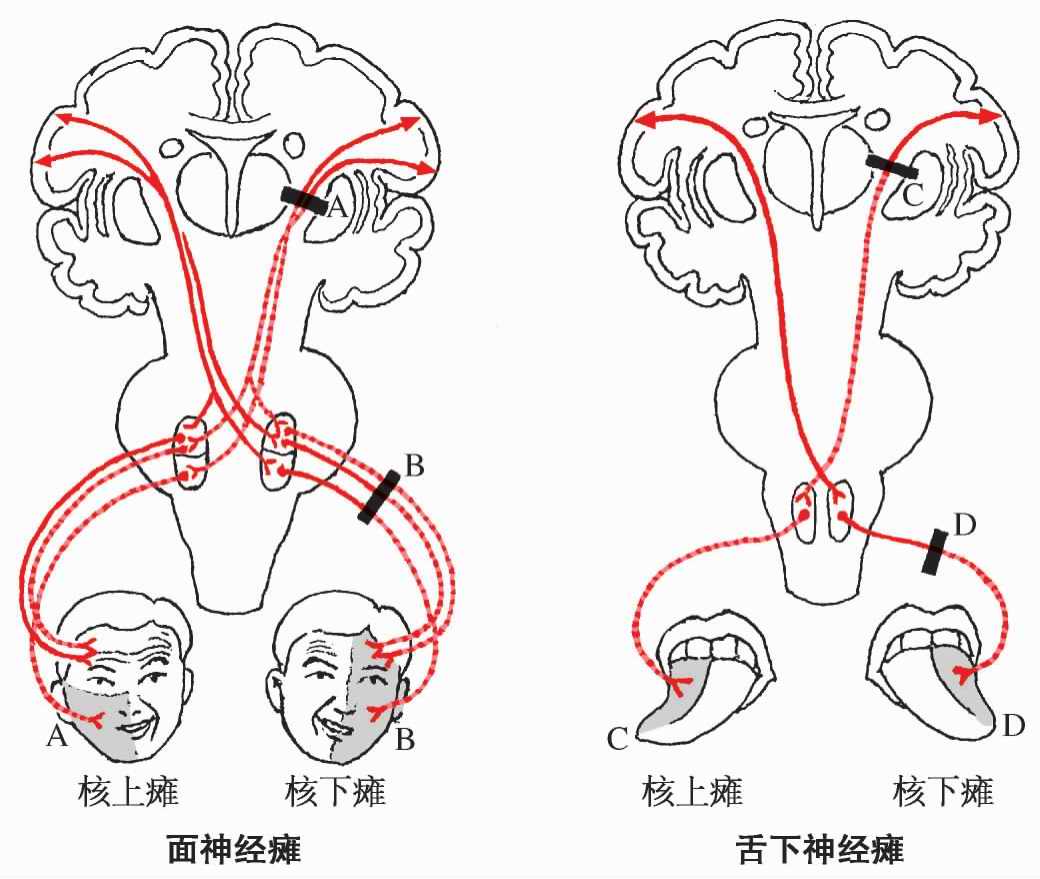 图5-66 震颤麻痹(Paralysis agitans)脑电地形图侧位图-脑电地形图学-医学