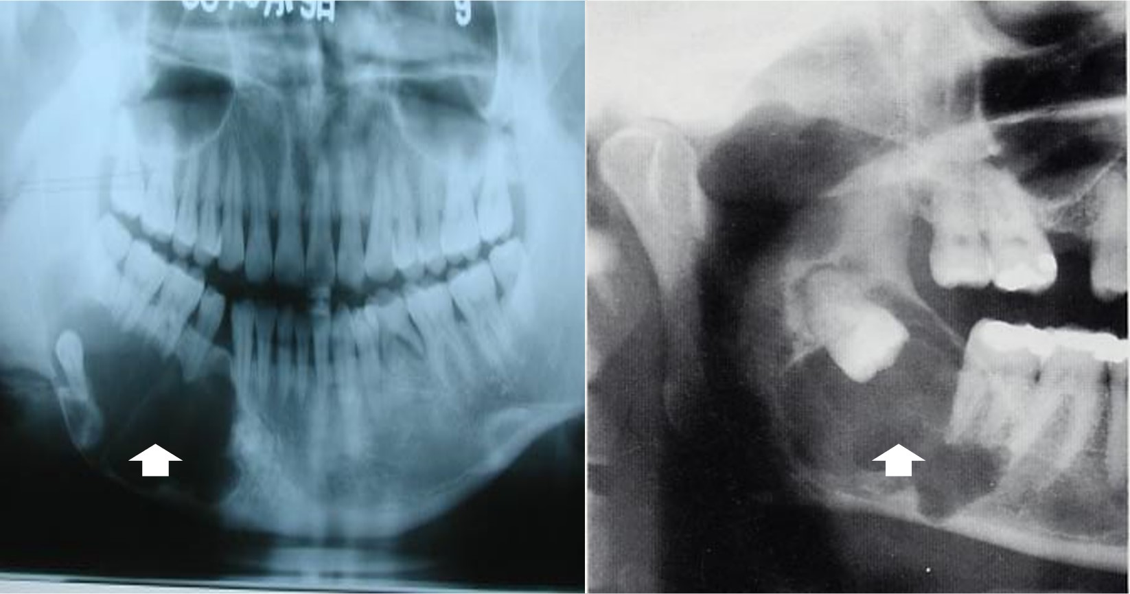 13.1-4 牙源性角化囊肿(X线).jpg