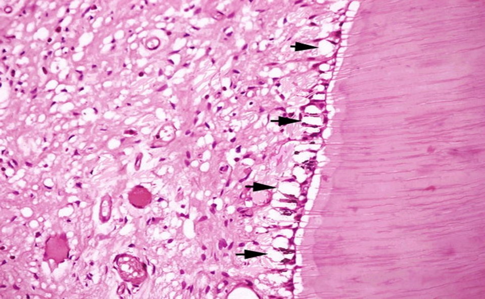 8.2-1 成牙本质细胞空泡性变.jpg
