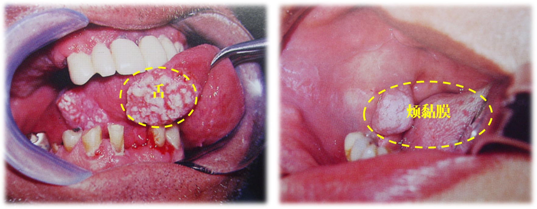 15.1-1 口腔癌好发部位.jpg