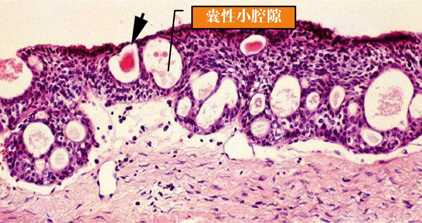 13.1-9 腺牙源性囊肿.jpg