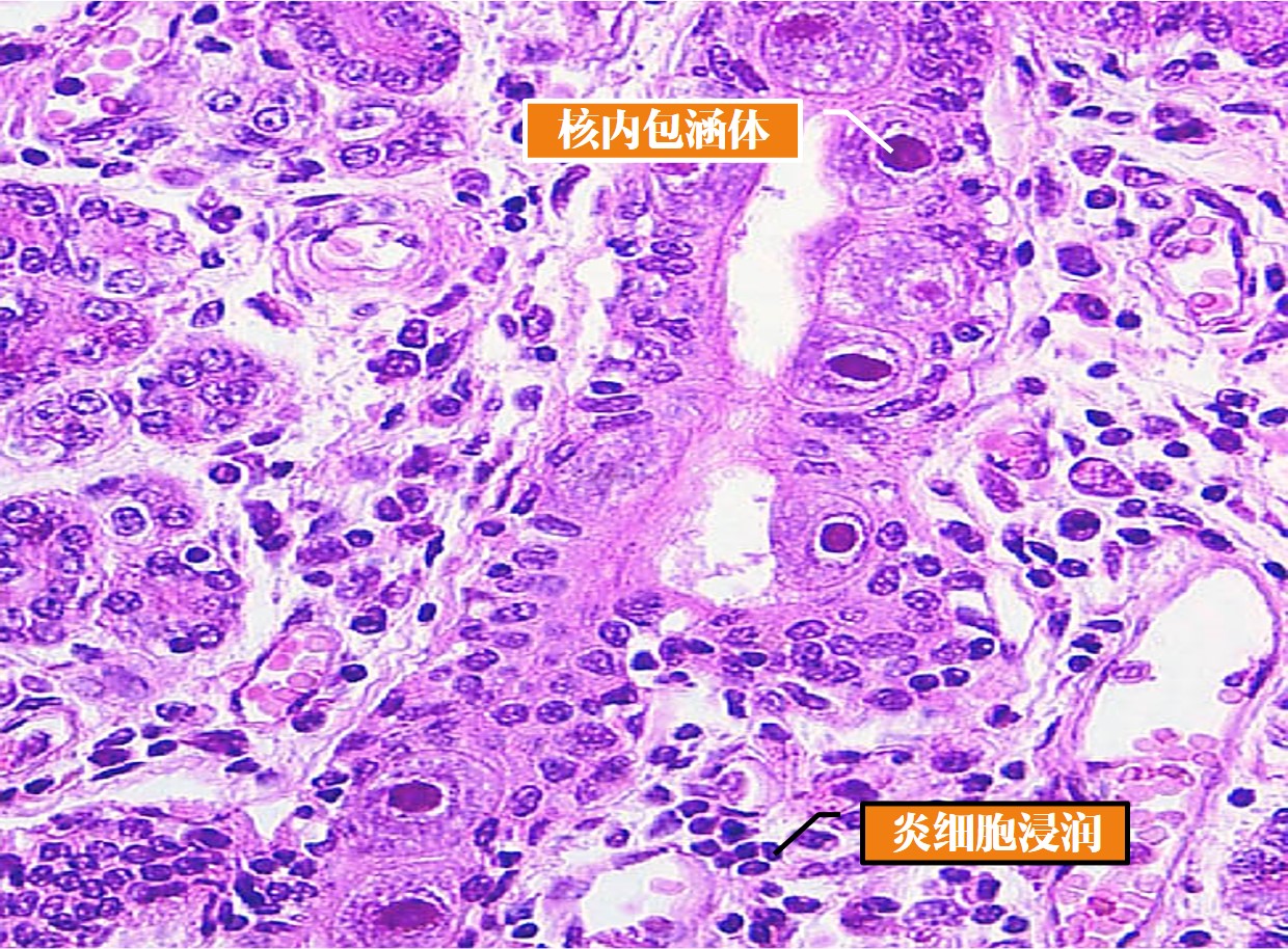 12.1-5 巨细胞包涵体病.jpg
