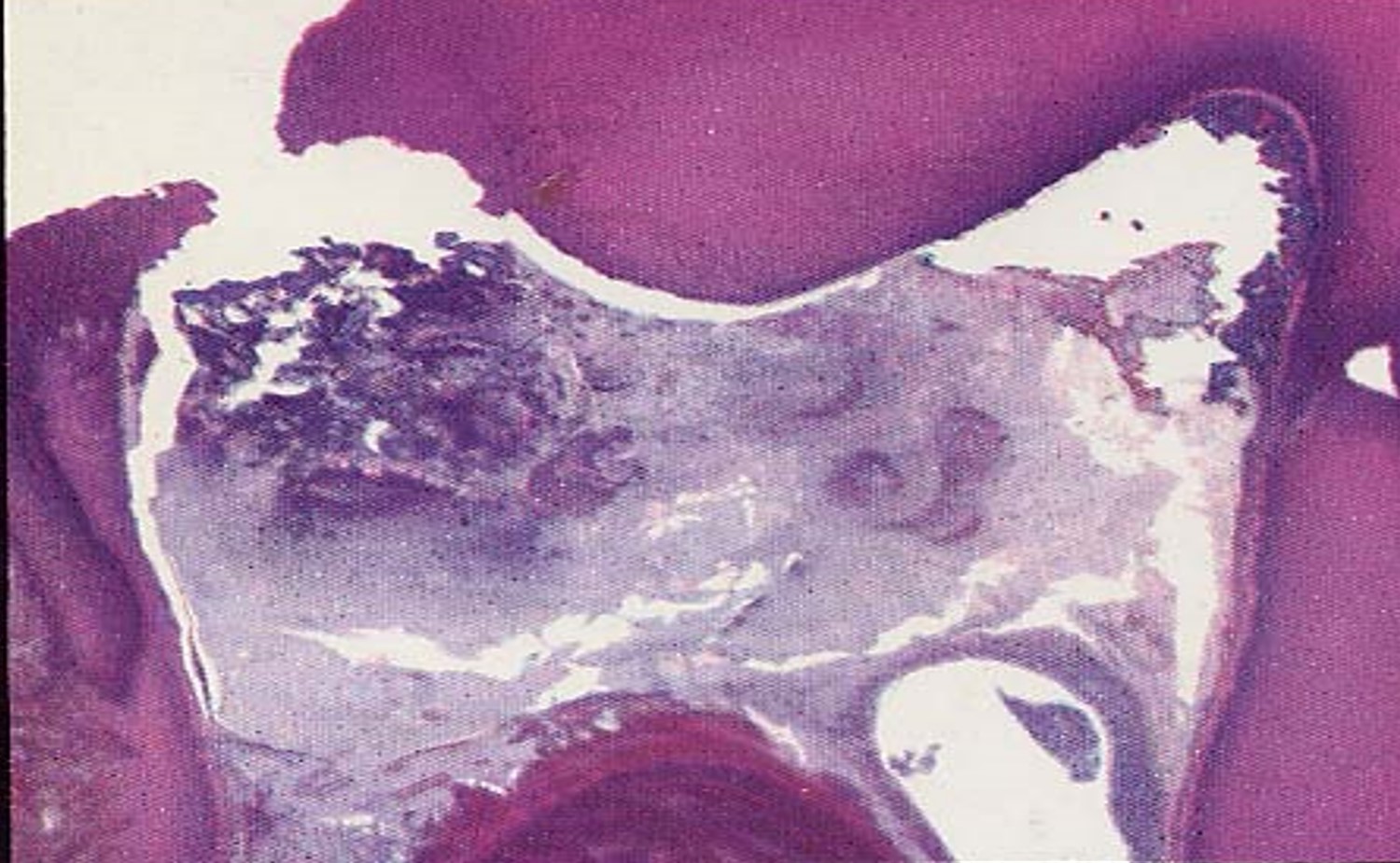 8.2-5 牙髓坏死.jpg