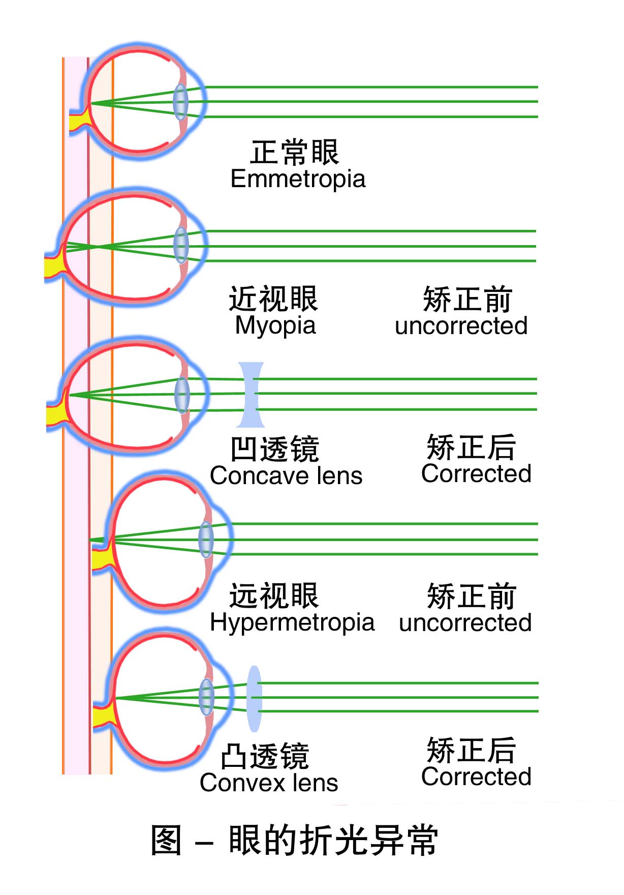 3-眼的折光异常 .jpg