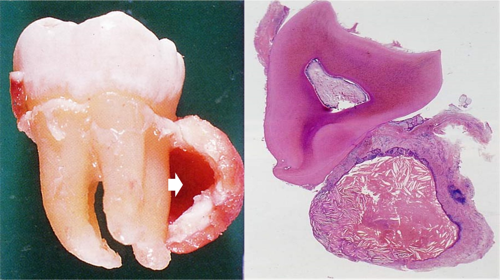 13.1-17 炎症性根侧囊肿.jpg