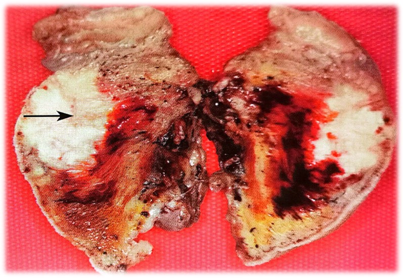 15.1-2 口腔癌(鳞状细胞癌).jpg