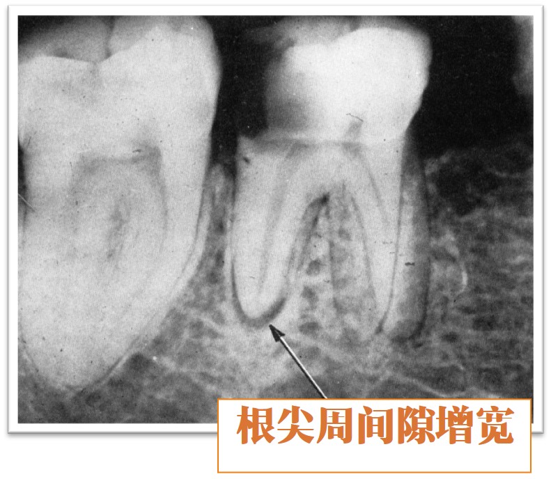 9.1-2 X线表现.jpg