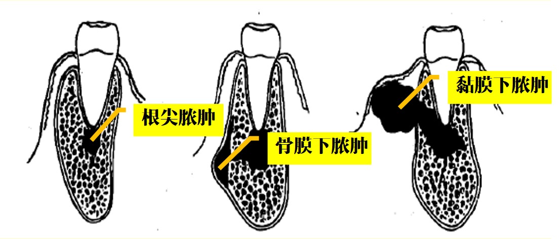 9.1-4 脓液引流途径.jpg