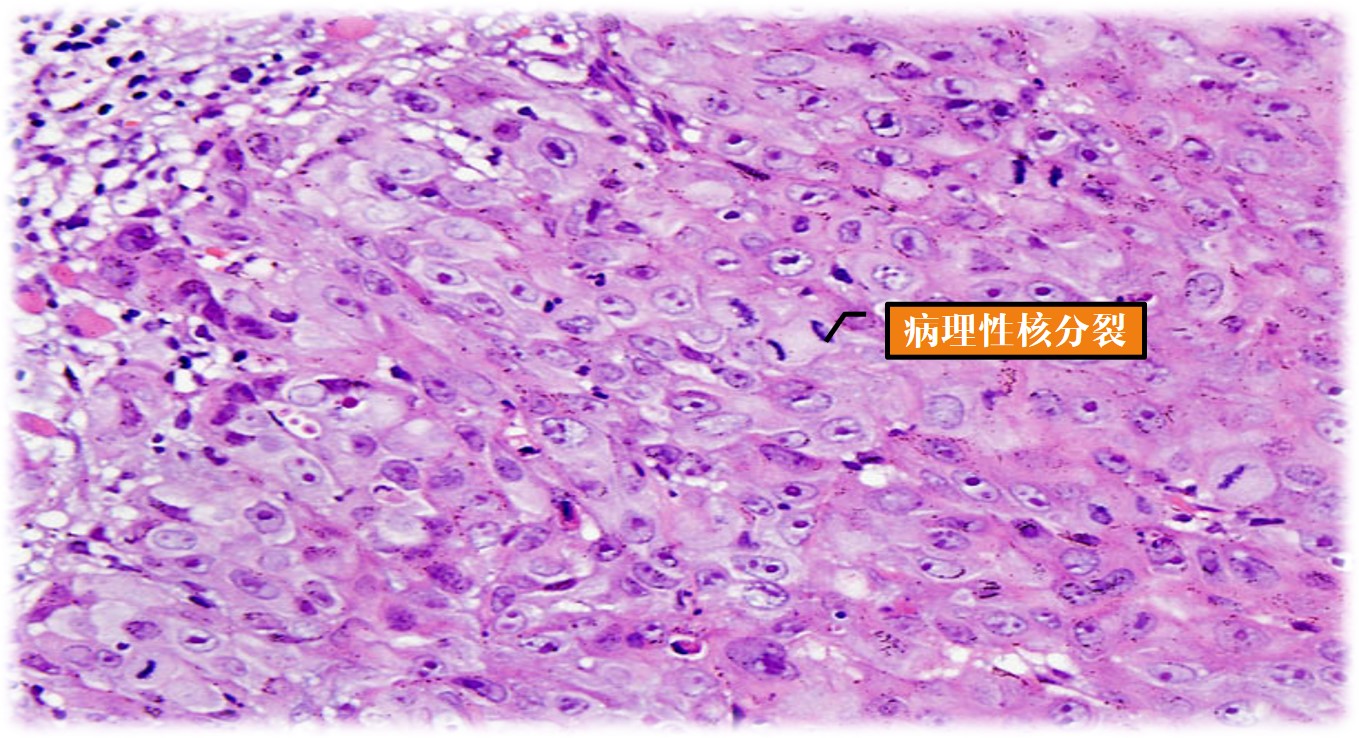 15.1-6 低分化鳞状细胞癌.jpg