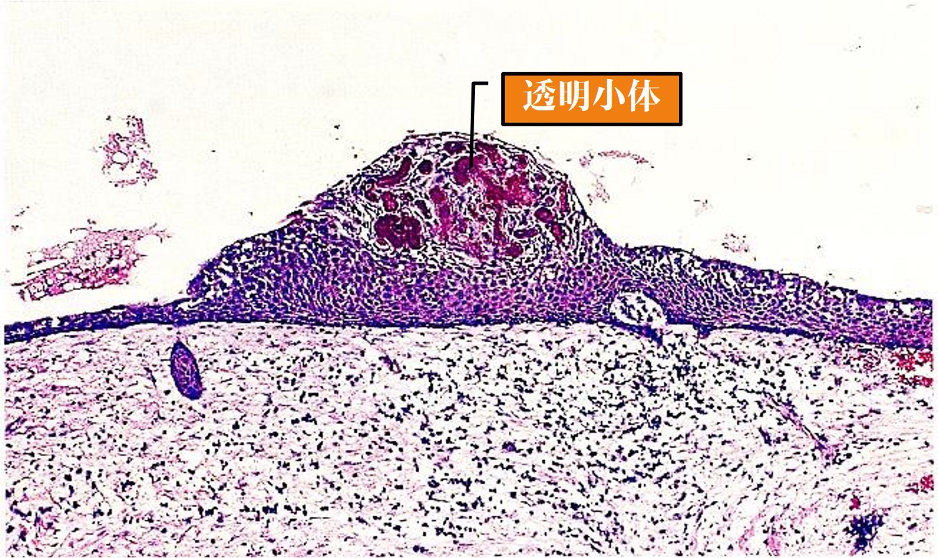 13.1-16 根尖周囊肿(透明小体).jpg