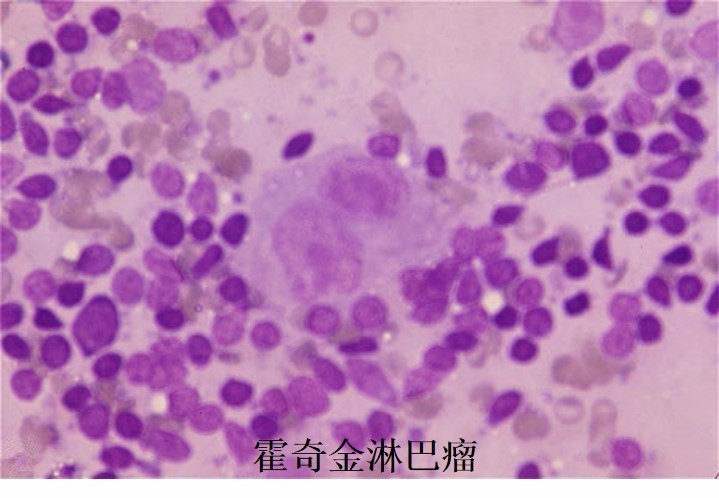 霍奇金淋巴瘤-3.jpg