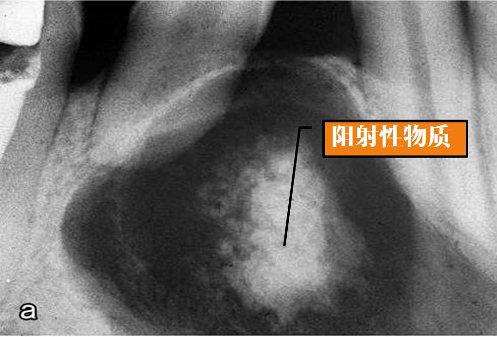 13.1-10 牙源性钙化囊肿(X线).jpg